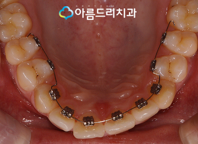 부분 설측교정비용 후기가 좋은 치과 관련 이미지 7