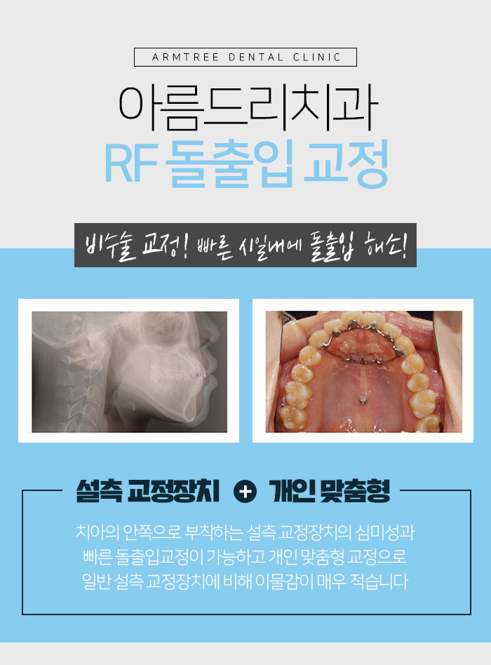 치아교정돌출입 교정후기가 중요햇 관련 이미지 5