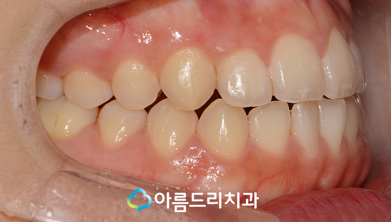 덧니부분교정 앞니 이런후기만 관련 이미지 9