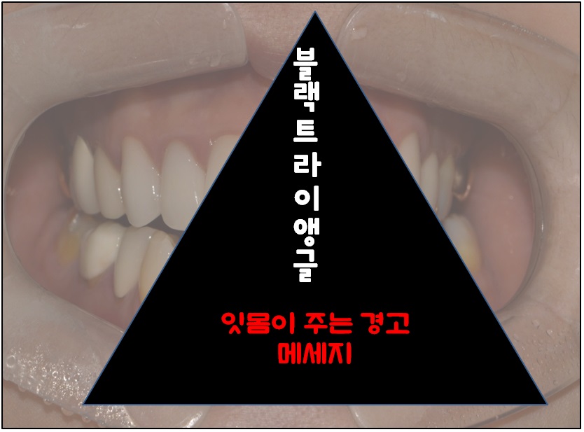 앞니 변색 _ 블랙 트라이앵글 #올 세라믹 관련 이미지 1