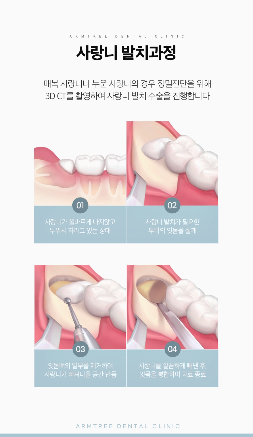 신논현 사랑니발치치과 선택은 신중해야만 관련 이미지 6