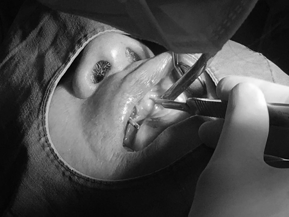 앞니 임플란트_뼈이식_신논현역 치과_아름드리 치과 관련 이미지 11