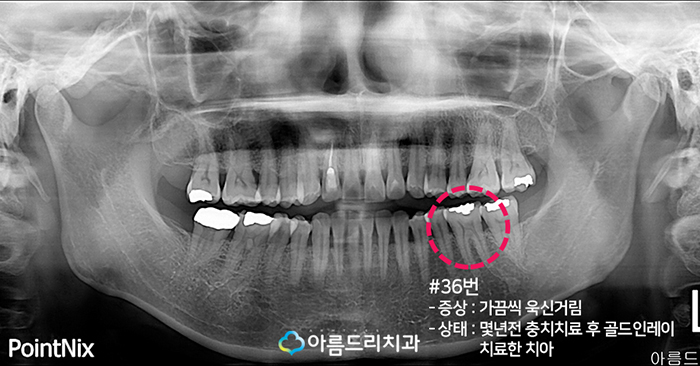 치아우식증 치료 증상과 예방법 관련 이미지 2