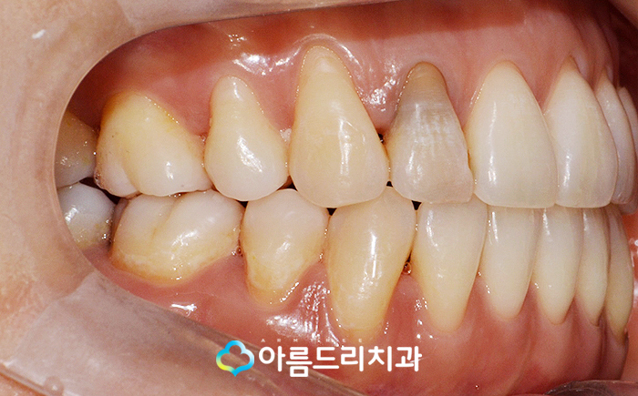 실활치미백 - 앞니변색을 해결하는 치료 관련 이미지 7