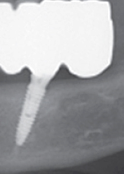 반포치과 전악임플란트는 풀아치 임플란트로 관련 이미지 13