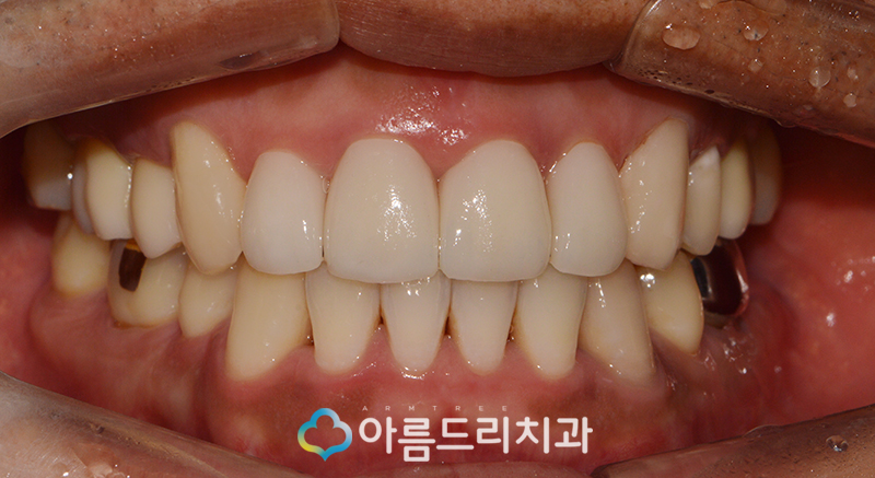 앞니 블랙트라이앵글 치아 이성형으로 해결 관련 이미지 10