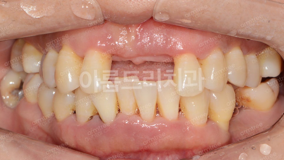 왜 임플란트와 치아교정을 다 잘아는 곳에서 치료해야할까?| 아름드리치과 진료일기 관련 이미지 6