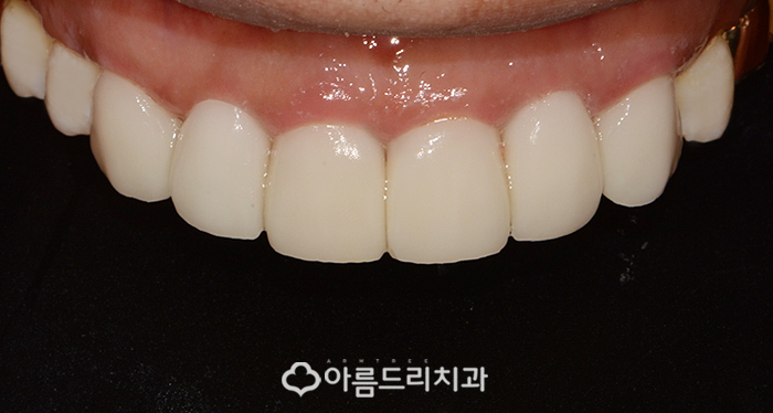 라미네이트교정 최소삭제 치아성형 후기 관련 이미지 8