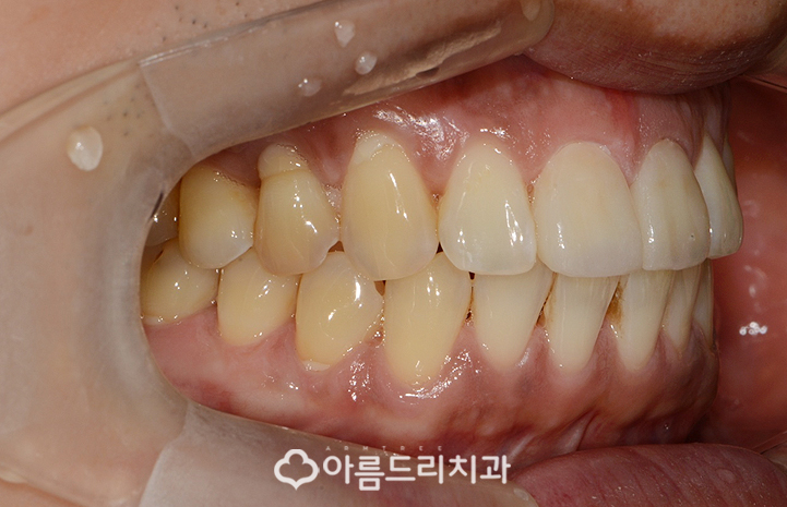 실활치미백 치은 잇몸퇴축 재생으로 동안치아 관련 이미지 9