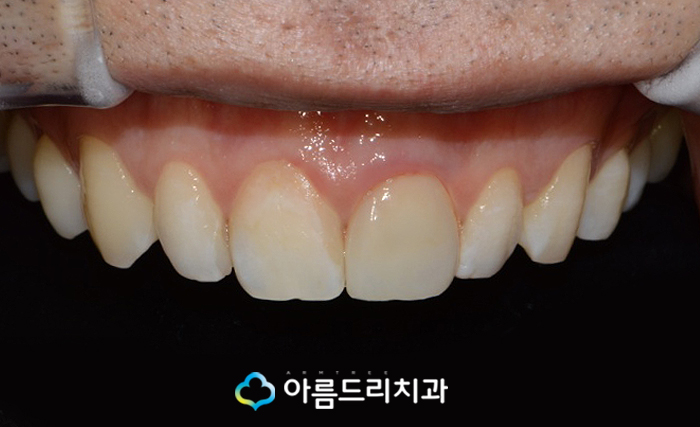 앞니 임시치아 전치부 크라운 재치료 관련 이미지 6