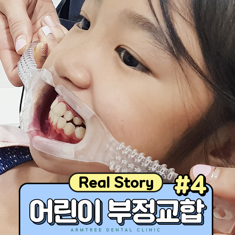 어린이 부정교합교정 RPE 악궁확장장치 관련 이미지 1