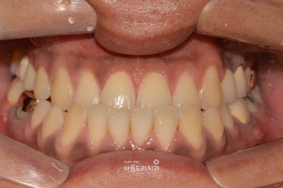 검은 잇몸! 잇몸미백으로 선홍빛 깨끗하게 관련 이미지 5