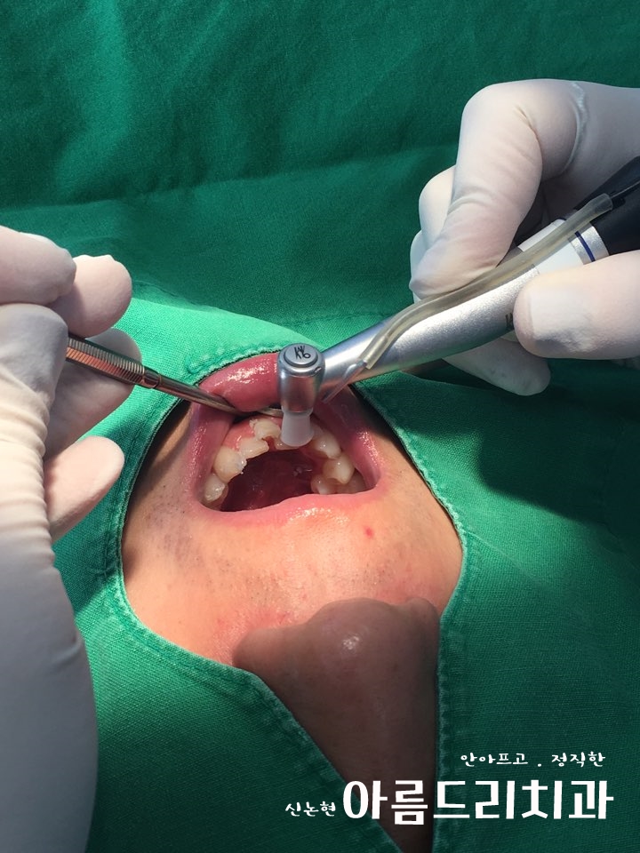 신논현역치과 아름드리치과에서 건강한 치아미백, 전문가 미백 관련 이미지 4
