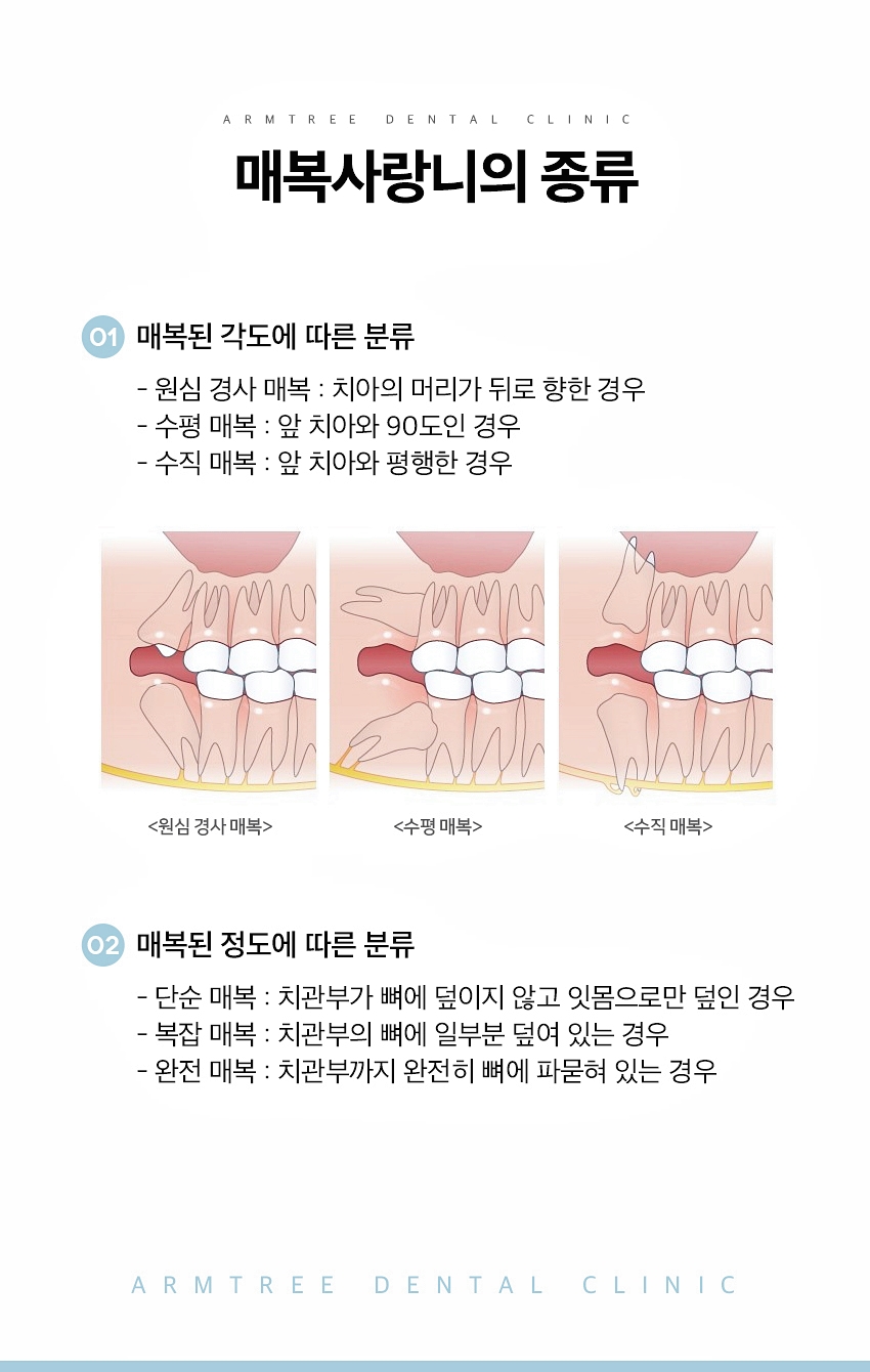 매복사랑니발치 통증없는 아름드리치과 관련 이미지 5