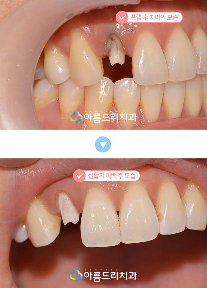 실활치 미백으로 앞니변색 해결후기 관련 이미지 6