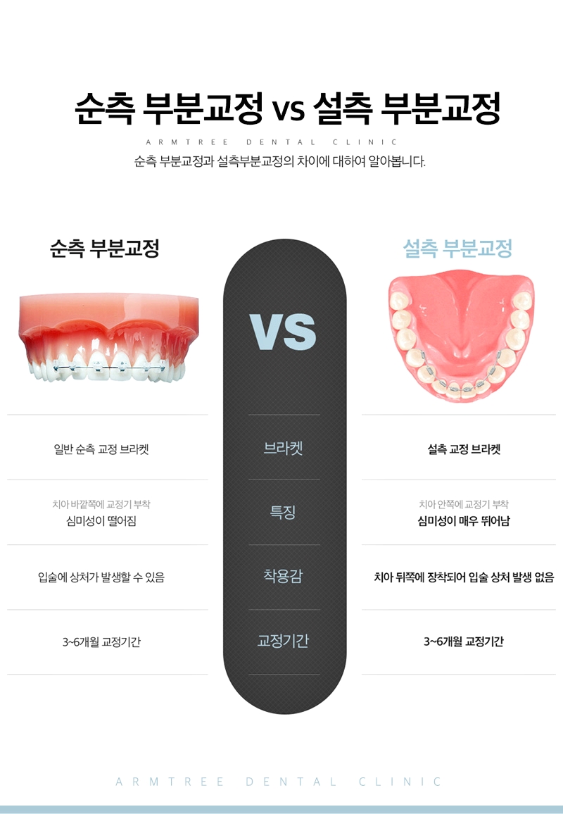 벌어진앞니교정 부분만 효과적으로 아름드리치과 관련 이미지 6