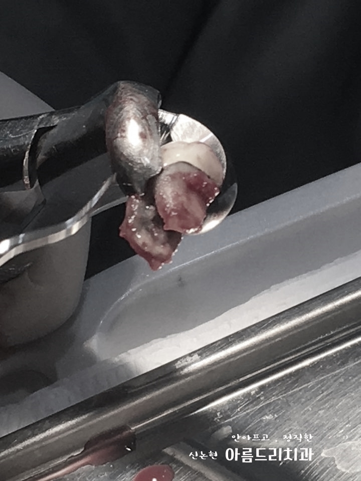 치아재식_임플란트 안 하고 치아 살릴 순 없나요?(신논현역 치과) 관련 이미지 4