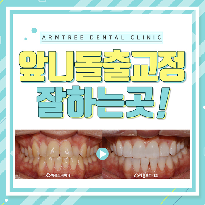 앞니돌출 앞니돌출교정 치과 아름드리 관련 이미지 1
