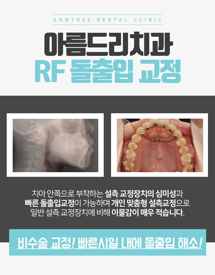 돌출입치아교정후기 돌출입설측교정 문제NO! 관련 이미지 3