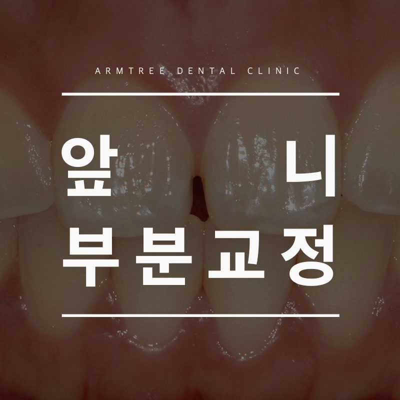 앞니부분교정후기 조화로운 아름드리치과 관련 이미지 1