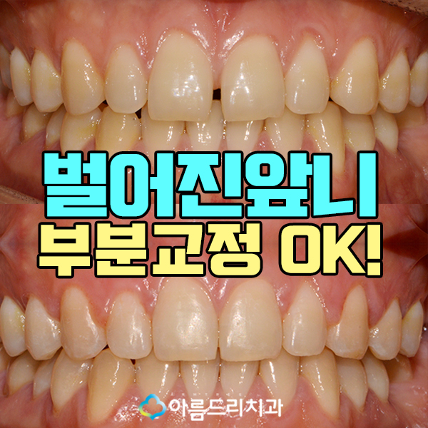 벌어진앞니부분교정 짧은기간 치아교정 관련 이미지 1