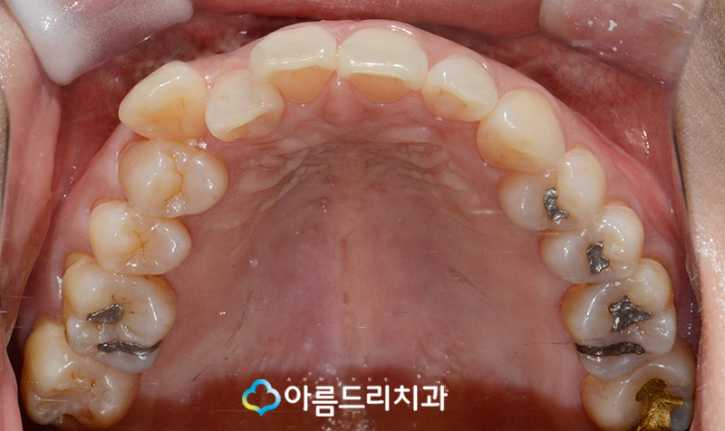드라큘라이빨 송곳니교정 부분교정후기 관련 이미지 11