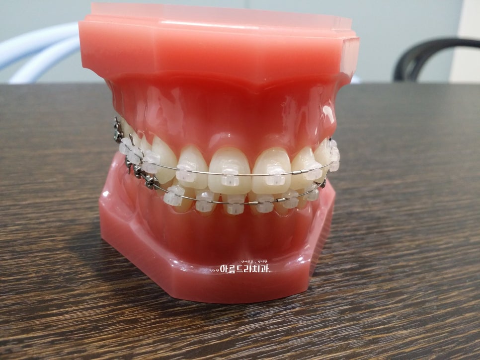 신논현치과 치아교정_앞니교정 계획 중이신가요? 관련 이미지 2