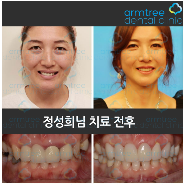 이현정 원장의 아름다운 당신 시즌 1 (8회 정성희 도전자) 임플란트, 신경치료, 치아성형, 올세라믹, 치아미백, 화이트랩스 관련 이미지 5
