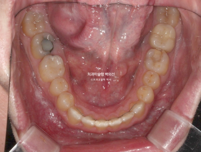 앞니 선천적 결손 인비절라인 임플란트 과개교합 치료 기간 관련 이미지 17