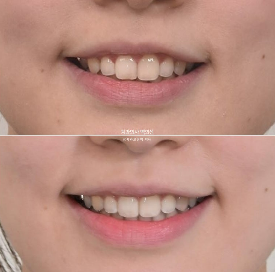 인비절라인 라이트 재교정 발치공간 벌어짐 ? 관련 이미지 12