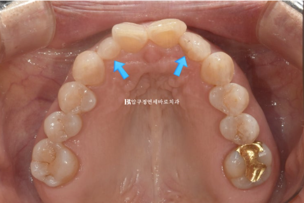 압구정 인비절라인|50대 앞니 부분교정부터 무삭제 라미네이트까지, 자연스러운 미소 완성 관련 이미지 4