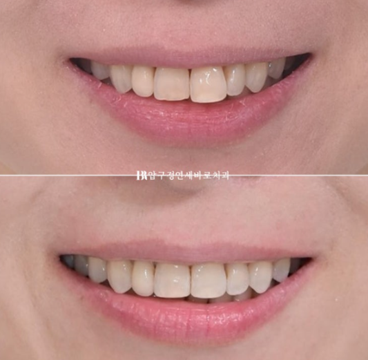 40대 인비절라인 라이트 가위교합? 관련 이미지 18