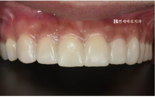 압구정 무삭제 라미네이트 가능할까? 관련 이미지 2