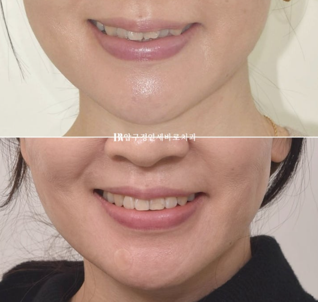 Orthodontics in Your 40s: Worried Your Gums Will Recede? | A 6-Month Front Teeth Partial Orthodontic Case That Also Improved Black Triangles image 10