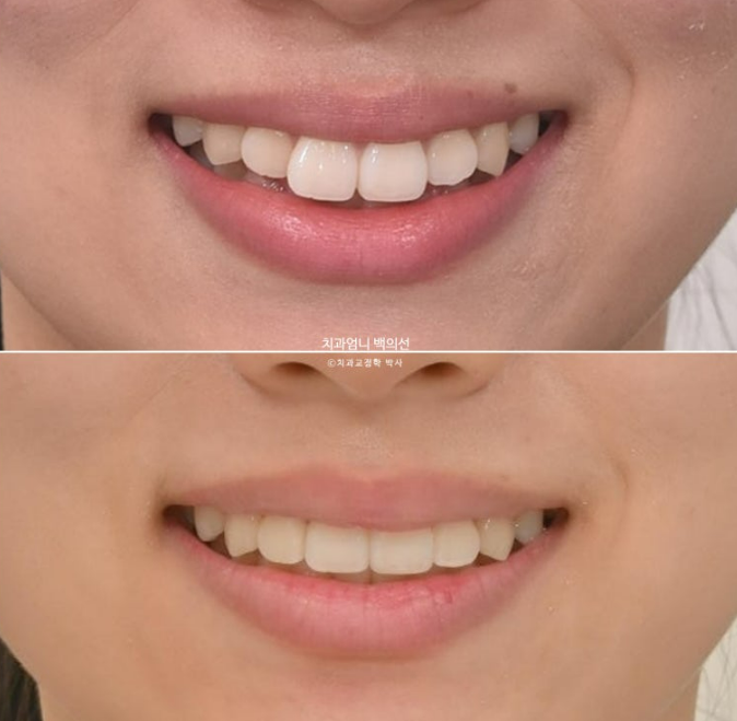 앞니 부분 교정 토끼이빨 덧니교정 ? 관련 이미지 17
