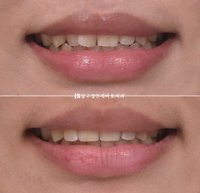 덧니교정 앞니부분교정 치간삭제 후기 관련 이미지 12