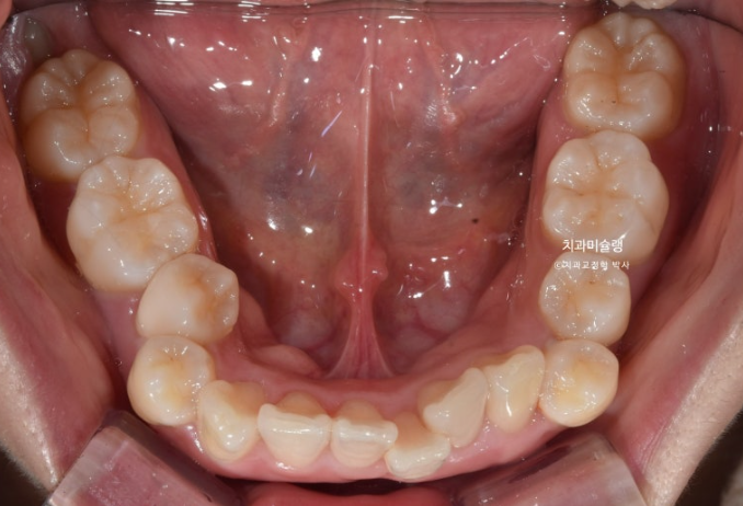 돌출입 덧니 발치 교정 인비절라인 교정 후기 관련 이미지 6