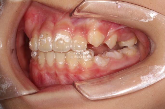 어린이 돌출입 교정 무턱 투명교정 인비절라인 퍼스트 관련 이미지 14