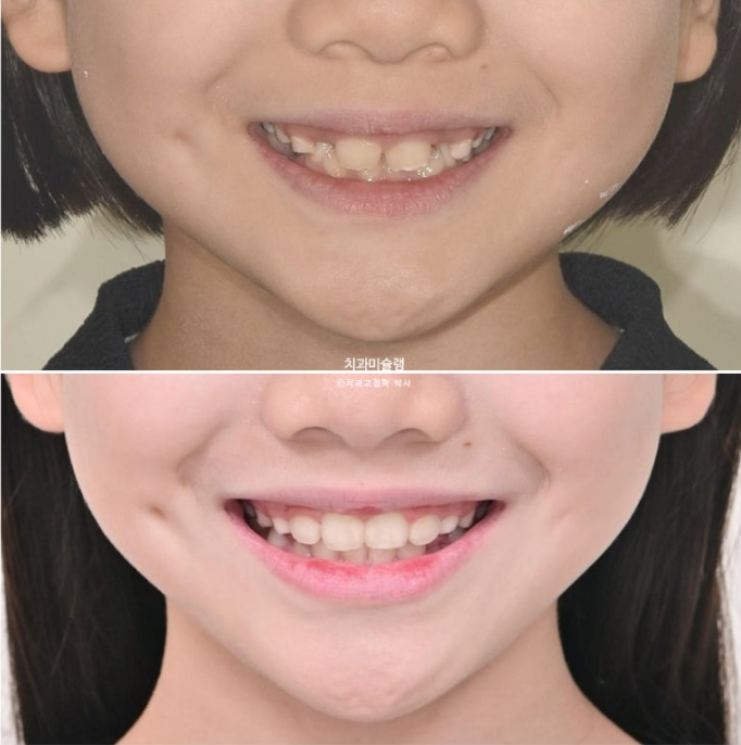 어린이 투명교정 인비절라인 퍼스트 과개교합 교정 후기 관련 이미지 23