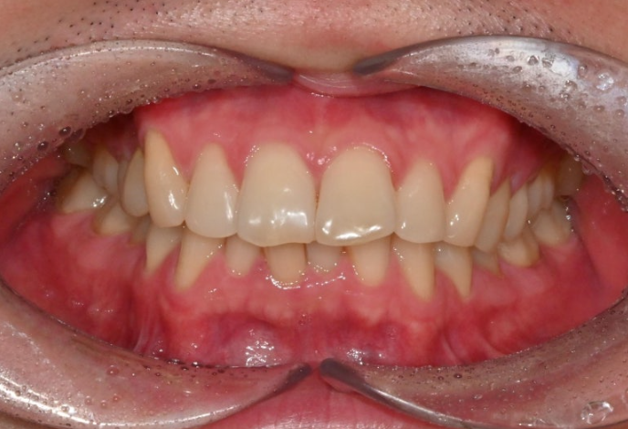 인비절라인 라이트 돌출 과개교합 중심선 교정 치간삭제 치료기간 관련 이미지 2