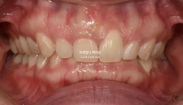 옥니·거미스마일·과개교합 교정 사례 | 클리피씨 교정과 잇몸성형으로 개선한 증례 관련 이미지 2