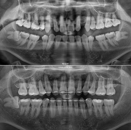 거미스마일 잇몸미소 발치 돌출입 과개교합 교정 후기 관련 이미지 17