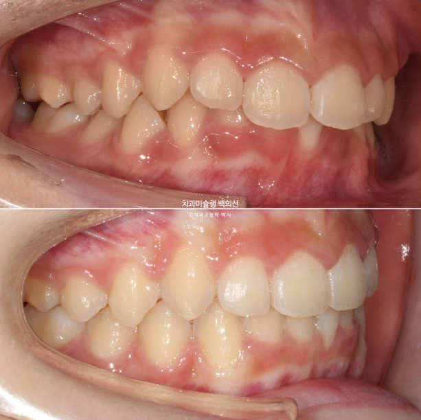 과개교합 인비절라인 모더레이트 컴프레헨시브 중심선 토끼이빨 관련 이미지 16