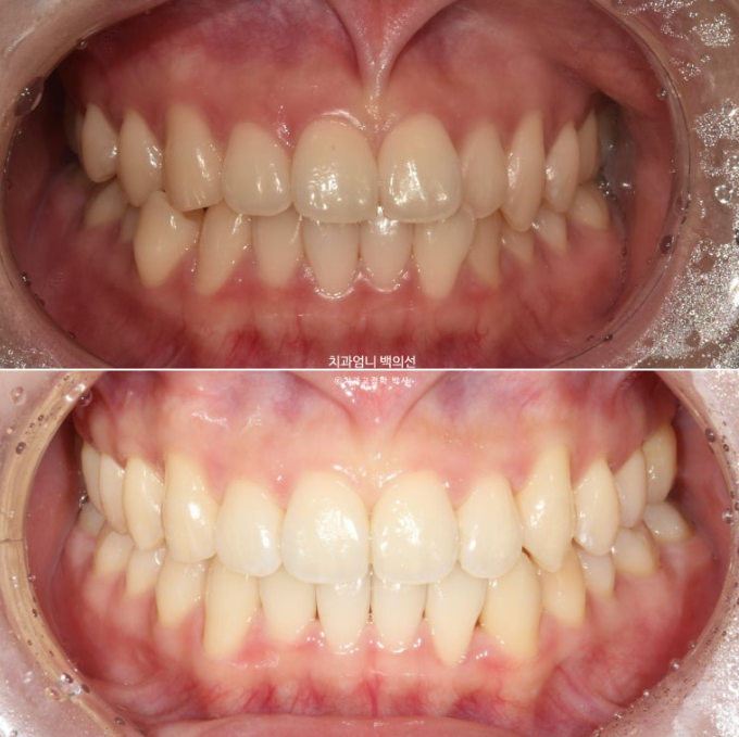 인비절라인 교정 비발치 비대칭 덧니 중심선 선천적 결손치 교정? 관련 이미지 1