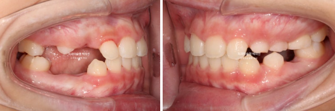 어린이 비대칭 반대교합 주걱턱 인비절라인 퍼스트 프리올소 성장 교정 관련 이미지 21