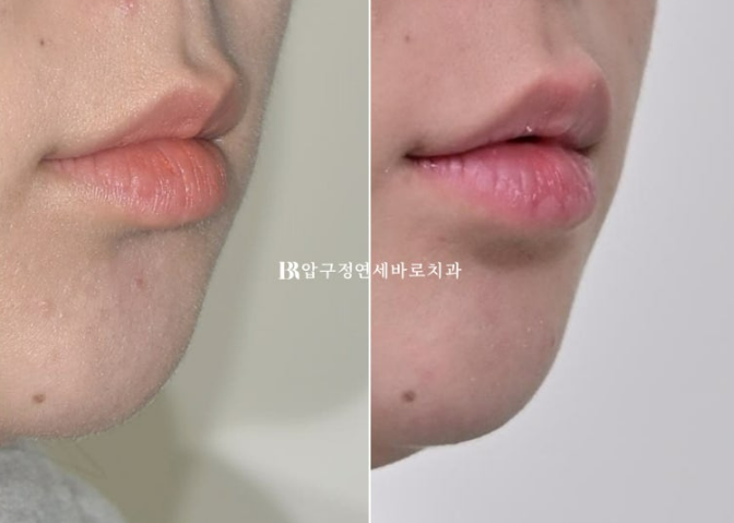 앞니 결손, 벌어진 치아 무삭제 라미네이트보다 먼저 해야 할 치료는? 관련 이미지 14