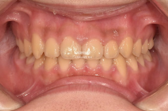 선천적 결손 잔존유치 과개교합 돌출입 인비절라인 퍼스트 어린이 투명교정 치료기간 관련 이미지 13