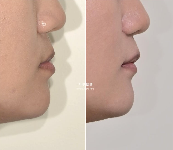 비발치 비수술 주걱턱 반대교합 재교정 치료 관련 이미지 19