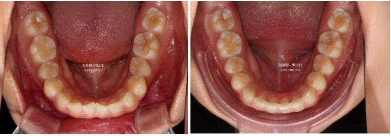 과개교합 옥니 거미스마일 교정 인비절라인 라이트 잇몸성형 후기 관련 이미지 15