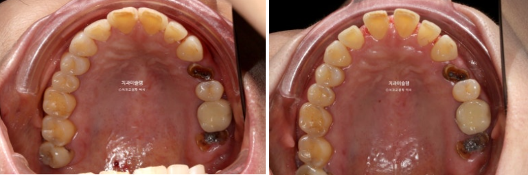 50대 치아교정 돌출 치아벌어짐 중년교정 관련 이미지 5